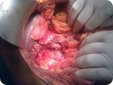 Surgery CA Pancreas 3